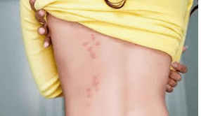 bed bug bites