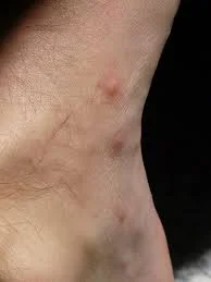 mosquito blisters