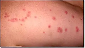 bed bug bites rashes